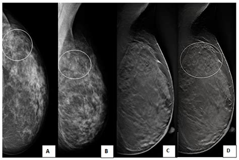 The Impact of Adding Digital Breast Tomosynthesis to BI-RADS ...