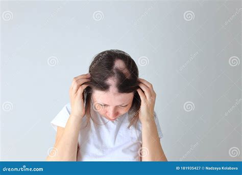 Real Alopecia Areata in a Young Girl. a Bald Head in a Person Stock Image - Image of alopecia ...