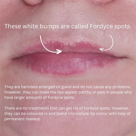 What are fordyce spots on lips causes treatment – Artofit