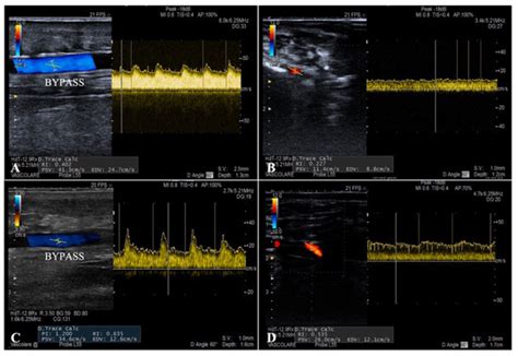 Duplex and Angiographic-Assisted Evaluation of Outcomes of Endovascular ...