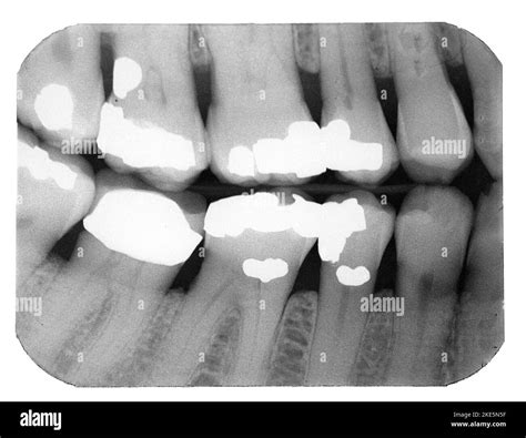 Teeth Anatomy X Ray at Declan Thwaites blog