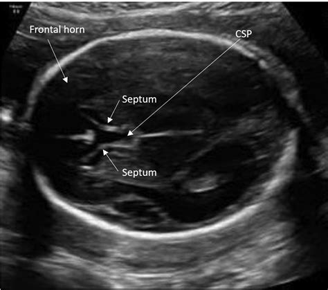 Absent Cavum Septi Pellucidi - American Journal of Obstetrics & Gynecology