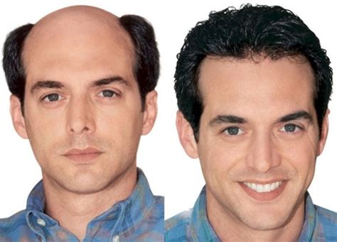 Hair Bonding in Chennai, Best Hair Bonding Services!