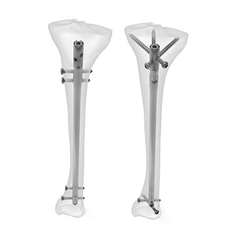 Intramedullary Nail Tibia 的图像结果