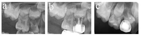 Survival Analysis and Risk Factors of Pulpectomy among Children with ...