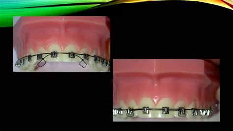 Image result for Auxiliary Root Torque Spring