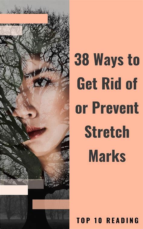 What Prevents Stretch Marks