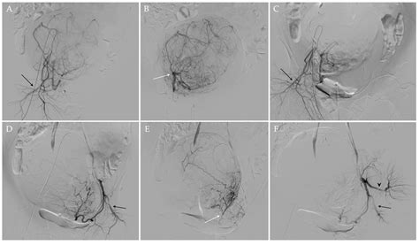 Uterine Artery Embolization for the Treatment of Symptomatic Uterine ...