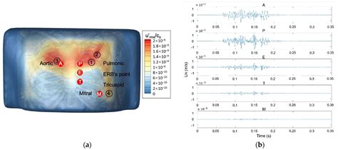 Mitral Valve Regurgitation Murmurs—Insights from Hemoacoustic ...