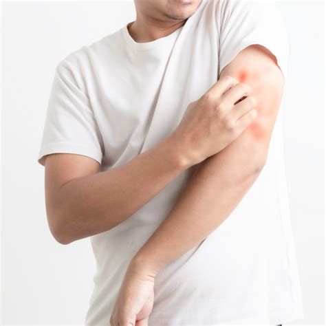 How to prevent itching and skin rashes during monsoon | SkinEasi – Skineasi