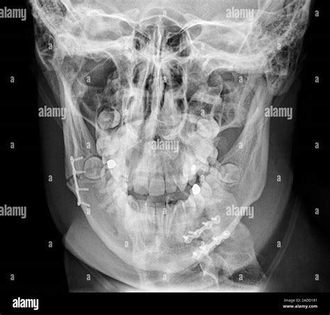 Jaw bone fracture repair, post-operative X-ray. The right mandible ...