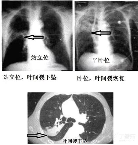 教你从肺CT上分辨是哪种细菌感染②丨肺炎克雷伯杆菌篇 - 呼吸胸外 -丁香园论坛