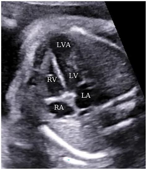 CHD | Free Full-Text | Prenatal Diagnosis of an Apically Located ...