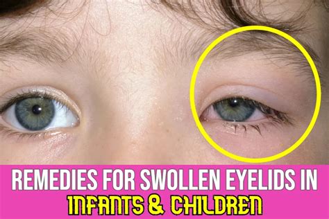 Swollen Eyelids In Infants & Kids: Causes and Remedies