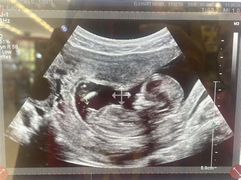 Ultrasound Pictures Of Baby Girl At 14 Weeks