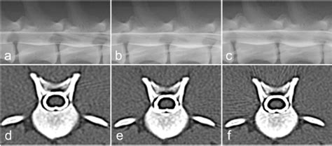 Image result for Myelogram Injection
