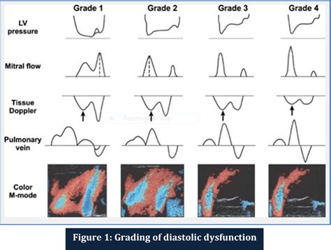 Image result for Moderate Diastolic Dysfunction
