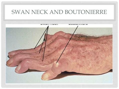 Image result for Hand Dysfunction