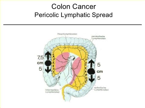 Kuvatulokset haulle pericolonic lymph nodes