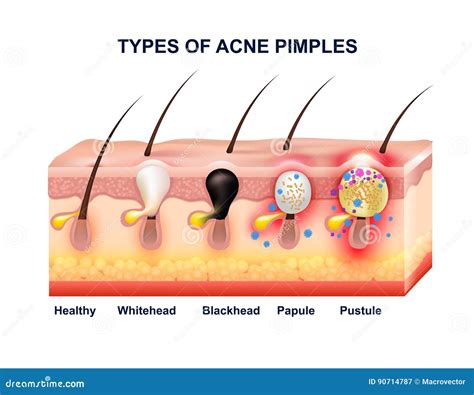 Skin Acne Anatomy Composition Stock Vector - Illustration of medical, infographics: 90714787