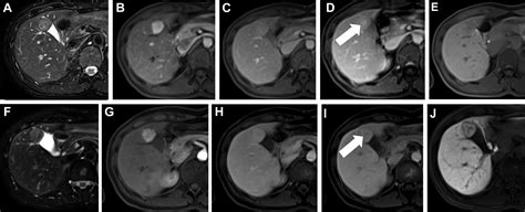 What Is A Mri Liver With Contrast at Helen Ball blog