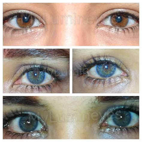 Image result for Eye Color Change Procedure