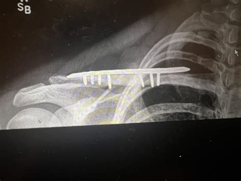 Your Questions, Answered: Treating A Broken Collarbone | Michigan ...