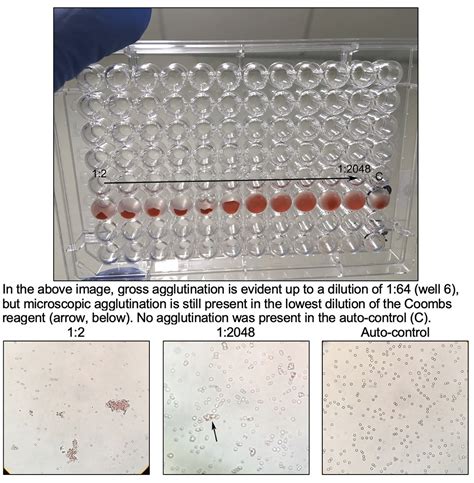 Image result for Coombs Test
