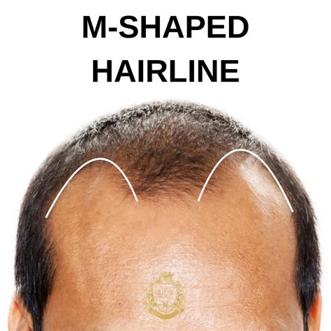 Qu'est-ce qu'une ligne de démarcation en forme de M ? - Hair Center of ...