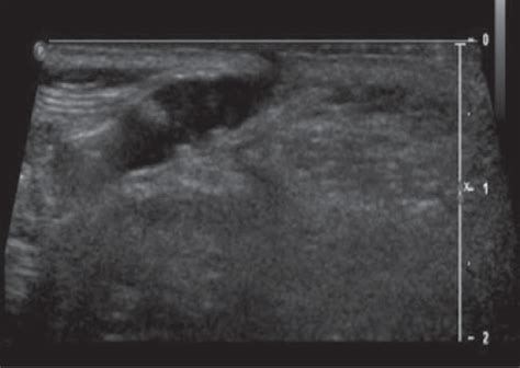 Sacral Dimple Ultrasound