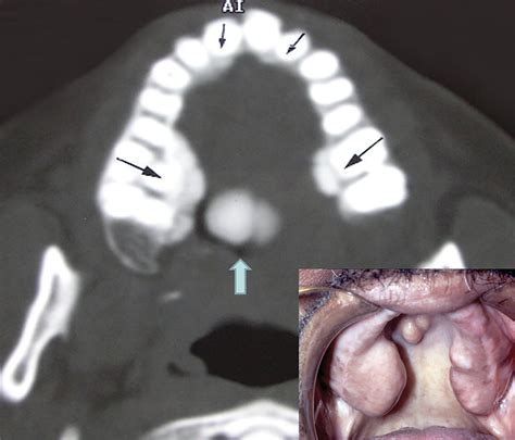 Imaging Torus Lesions of Jaw Bones | Applied Radiology