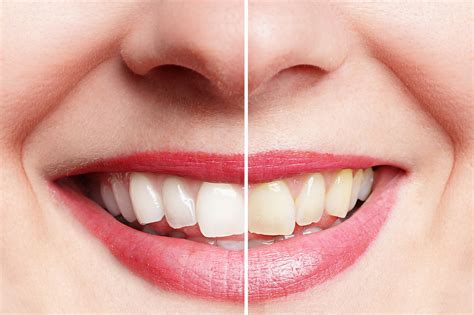 What's the Best Way to Whiten Teeth?: 10 Tips for a Pearly White Smile