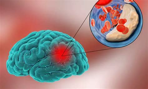 Indobufen valuable option for secondary stroke prevention among ...