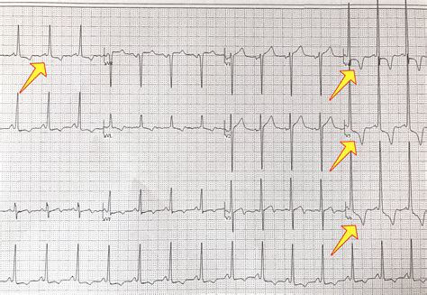 Hypertrophic cardiomyopathy, HCM and HOCM - Doctablet®