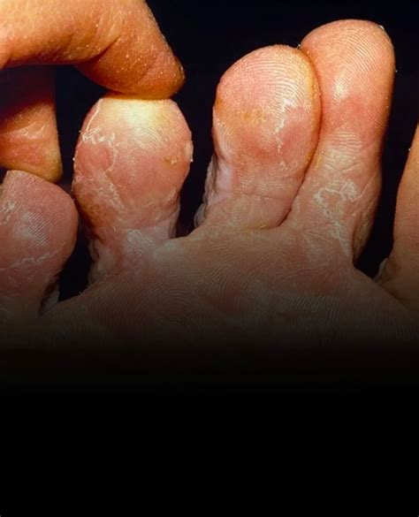 Tiña Pedis (pie de atleta) - Clínica Jaime Vilar