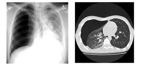 Pneumothorax - Symptoms, Treatment of Pneumothorax | healthy lungs