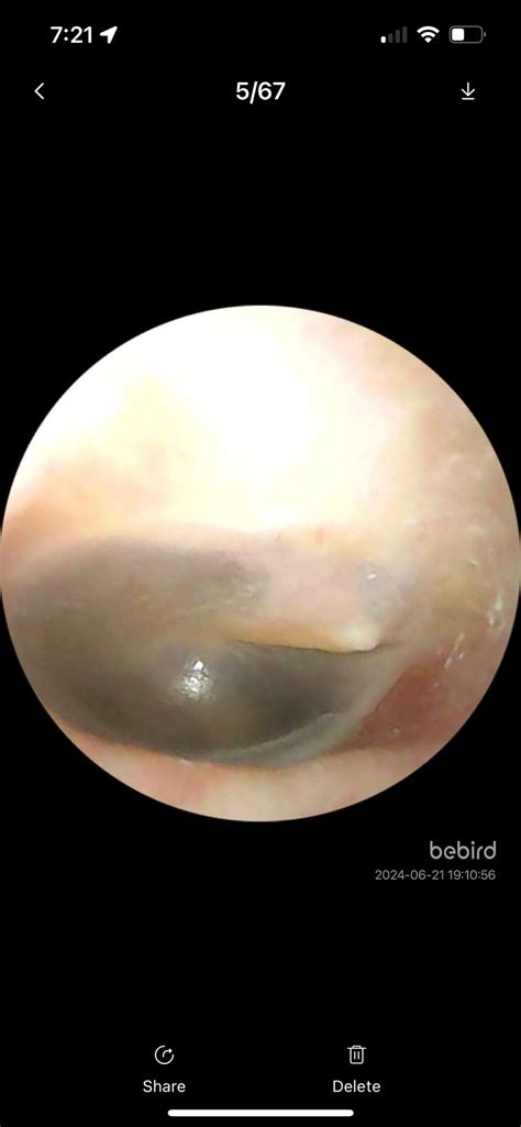 Does this look like I have fluid behind my ear drum ? Dizzy for about a ...