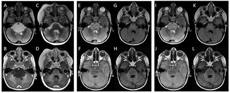 The Role of Reirradiation in Childhood Progressive Diffuse Intrinsic Pontine Glioma (DIPG): An ...