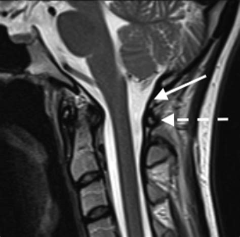 Cranio Cervical Instability
