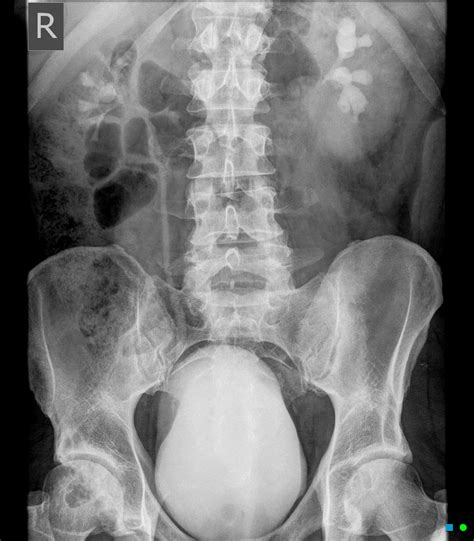 Labeled Kub X Ray Anatomy at Joan Bowler blog