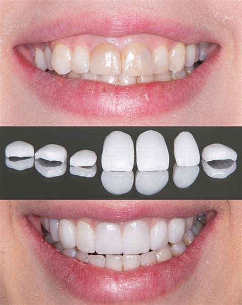 Veneers Teeth Treatment at Joan Fleming blog