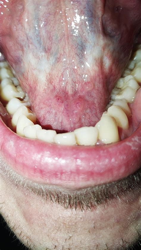 White Bumps On Back Of Tongue