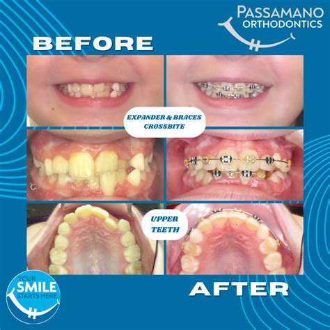 What Is Braces Expander at Aidan Penton blog