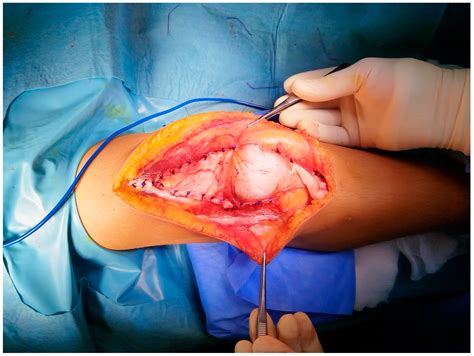 Poor Prognostic Factors in Surgically Treated Habitual Patellar ...