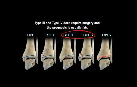 Salter harris type 2 - fitypartners