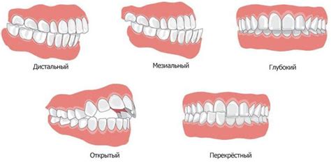 Дистальный прикус (дистальная окклюзия) — фото до и после, признаки у ...