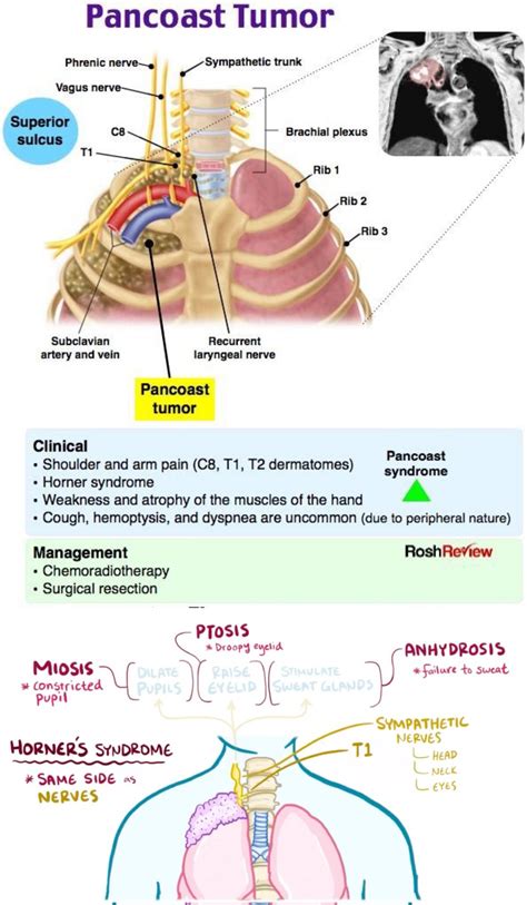 Pancoast Tumor Neck