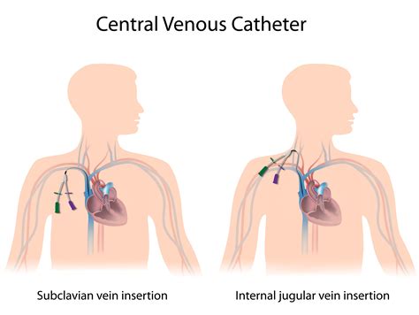 Jugular Vein Catheter Radiology at Audrey Stier blog