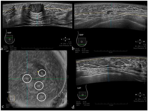 Pros and Cons for Automated Breast Ultrasound (ABUS): A Narrative Review