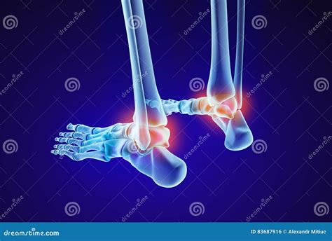 Talus Fracture And Broken Leg With Swelling Ankle Symptom Outline Diagram Vector Illustration ...